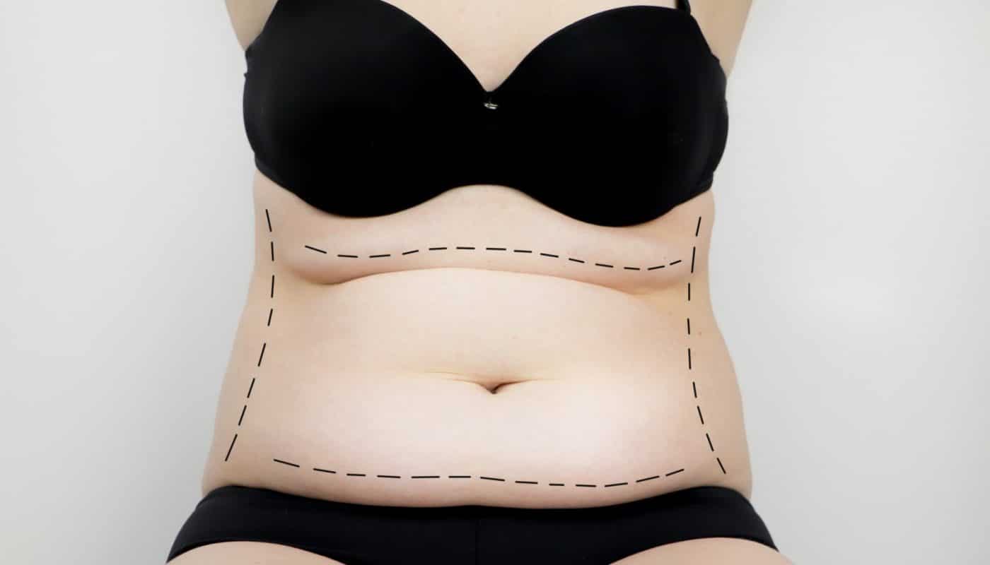 L'abdominoplastie